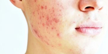 Cravos e espinhas - Créditos: depositphotos.com / irinaantokolskaya@gmail.com