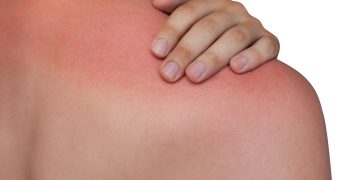 Queimadura solar - Créditos: depositphotos.com / Dimid_86